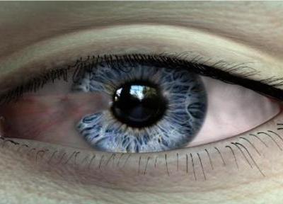 درمان بیماری ناخنک چشم درمان بیماری ناخنک چشم