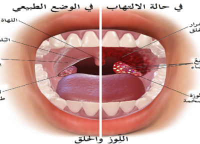 درمان گلو درد بدون دارو در خانه درمان گلو درد بدون دارو در خانه